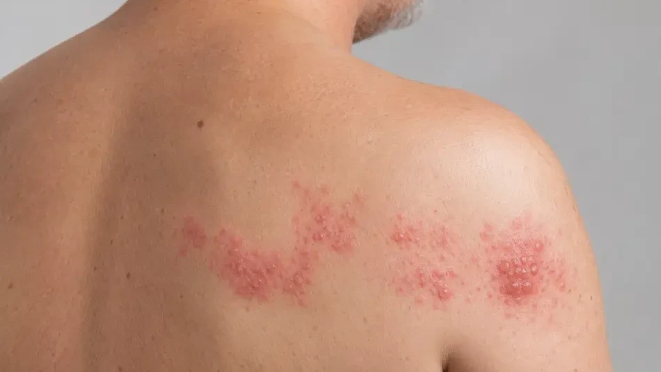 Zona : une maladie trés douloureuse et  handicapante, mais contre laquelle il est possible de se protéger par la vaccination  