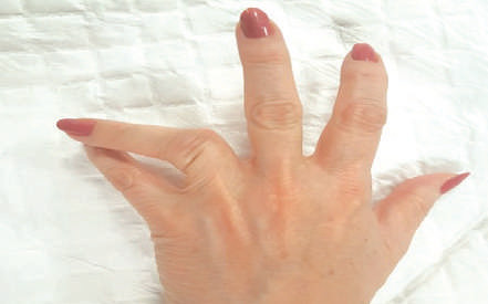 La luxation des doigts : Quel traitement ?