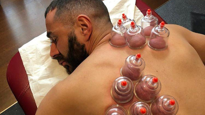 Hijama : Les bienfaits des ventouses sur le dos