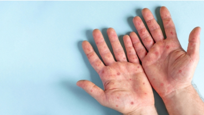 Risque de propagation du Mpox : les explications de Tayeb Hamdi