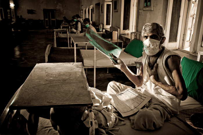 Tuberculose: Plus de 1,2 million de morts en 2024, avertit l'OMS