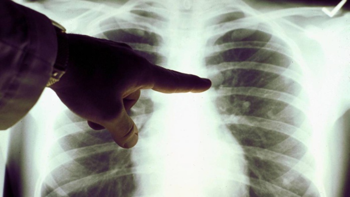 Tuberculose : Malgré les efforts, l’objectif 2030 est loin d’être réalisable