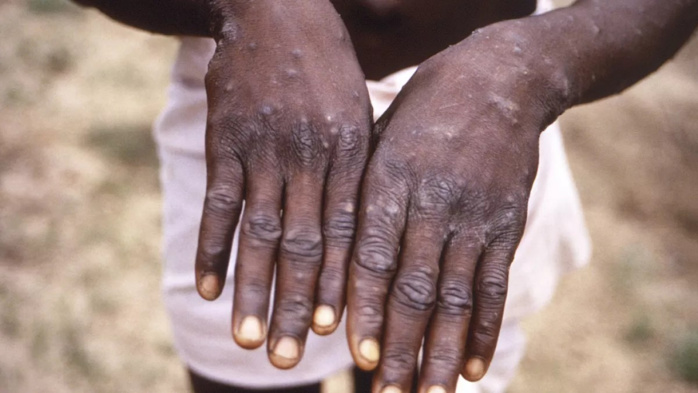 Mpox: L'OIM lance un appel de fonds pour une aide d'urgence aux populations touchées