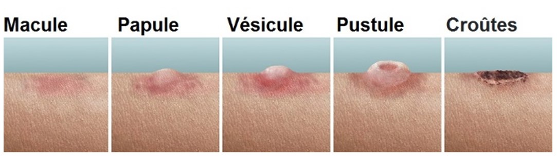 10 différences pour distinguer la variole du singe de la varicelle