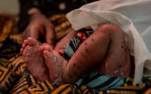 Mpox: le nombre des cas en Afrique a atteint 38.300 dont 7.339 confirmés et 979 décès